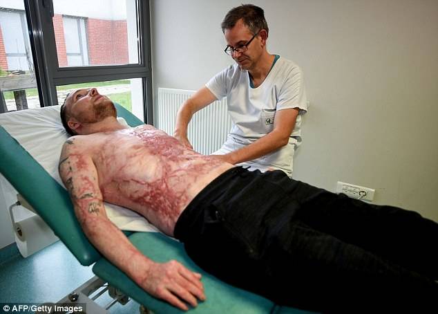 فرانس: جھلسے شخص کو جڑواں بھائی کی جلد لگادی گئی، اپنی نوعیت کا پہلا آپریشن ہے